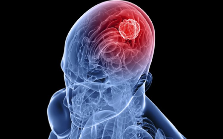 World Brain Tumor Day: जानिए विश्व ब्रेन ट्यूमर दिवस के अवसर पर क्या हैं  ब्रेन ट्यूमर के लक्षण और उपचार