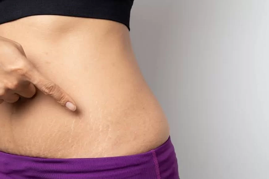 Pregnancy Stretch Marks: जानिए प्रेगनेंसी के बाद कैसे पा सकते हैं स्ट्रेच मार्क्स से छुटकारा?